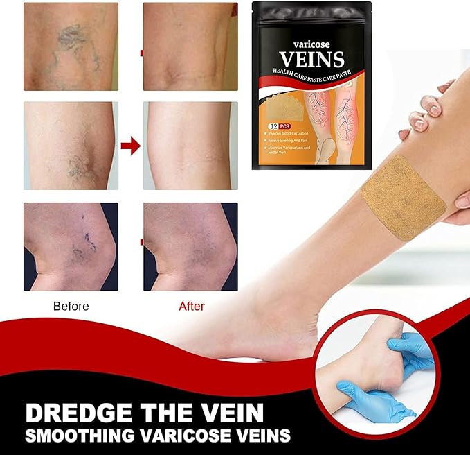Varicose Veins Remover For Legs